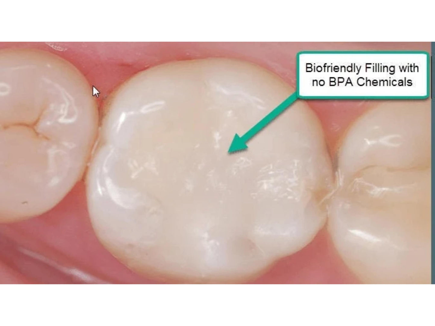 Chipped Tooth Filling Kit DIY Fix, Broken Teeth Emergency Repair Crafting Kit, Composite Filling (not a medical device)