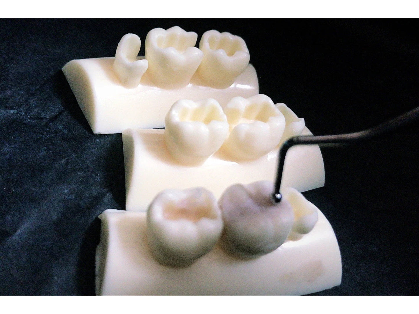 Chipped Tooth Filling Kit DIY Fix, Broken Teeth Emergency Repair Crafting Kit, Composite Filling (not a medical device)